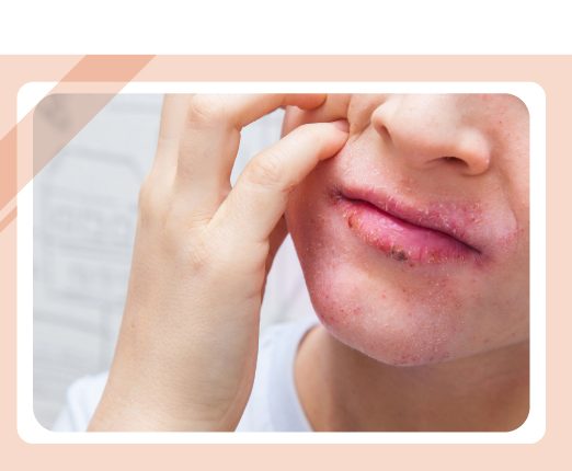 راهنمای جامع اگزما صورت