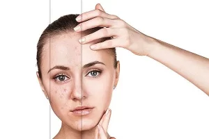آشنایی با لیزر کربن (پیلینگ هالیوودی)